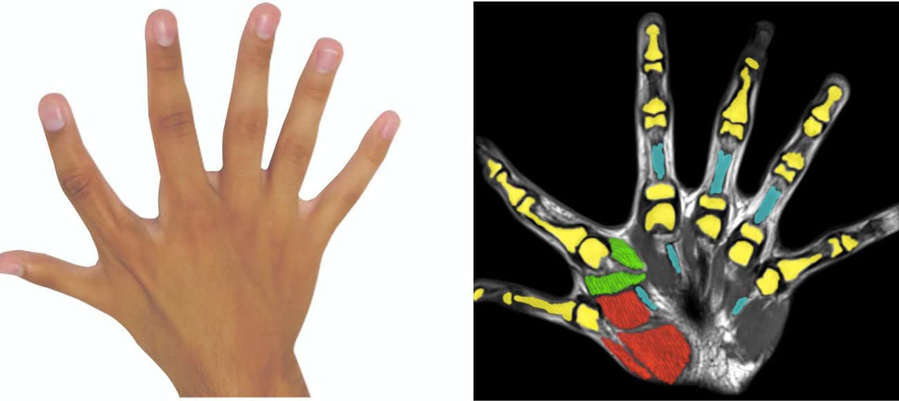 People born with extra fingers or toes requires extra brain's resources