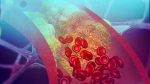 A whole new way of detecting blood clots