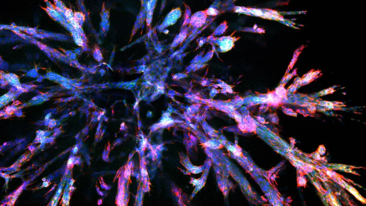 Stained pancreatic cancer organoid