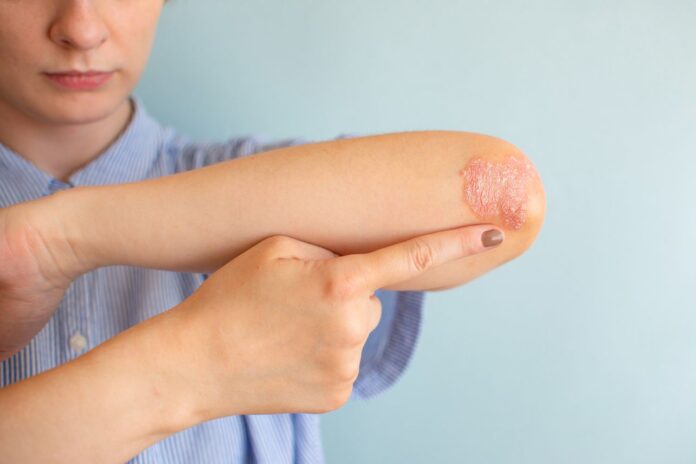 Psoriasis of a women on her elbows