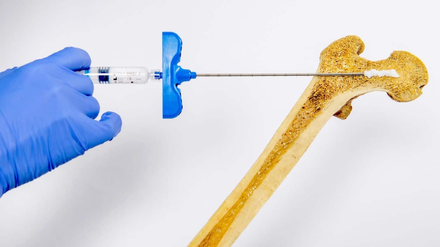 Injectable Hydrogel Offers Rapid Bone Density Increase for Osteoporosis Treatment